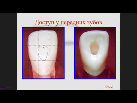 Видео: 2019 01 22 ВОЛКОВ Д П    Эндодонтия глазами реставратора  Оптимизация эндодонтического доступа