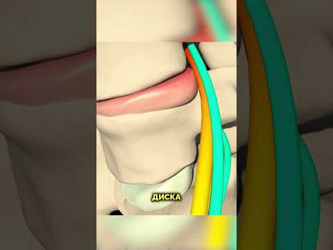 Видео: Сильний біль в спині. Міжхребцева грижа