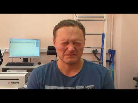 Видео: Парез лицевого нерва, восстановление мимических мышц.