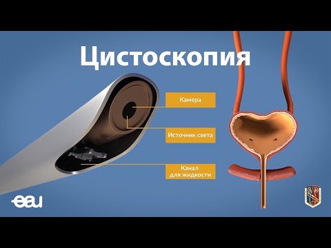 Видео: Цистоскопия (EAU - cystoscopy RU)