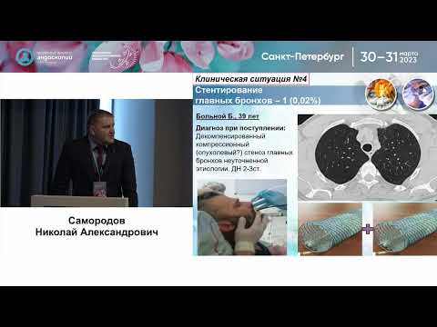 Видео: «Неформат» в бронхологии: редкие и нетипичные ситуации в респираторной эндоскопии