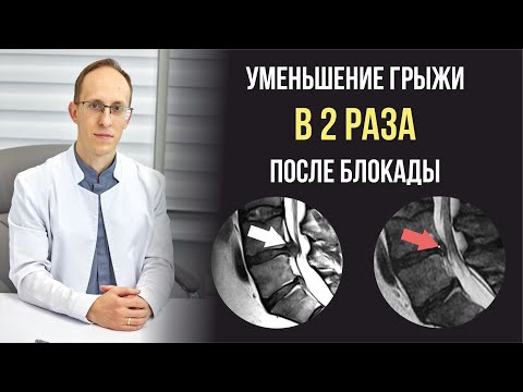 Видео: Влияние блокад на процесс уменьшения грыж позвоночника