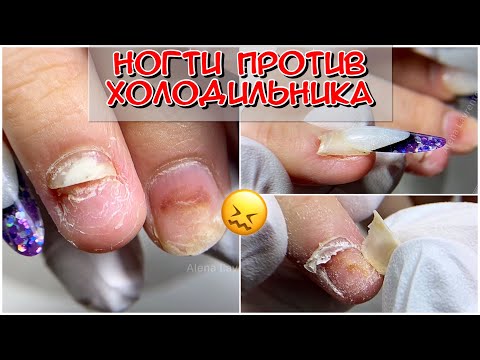 Видео: Ногти против холодильника / Сломала ногти / Уронила на пальцы холодильник / Онихолизис / Отслойки