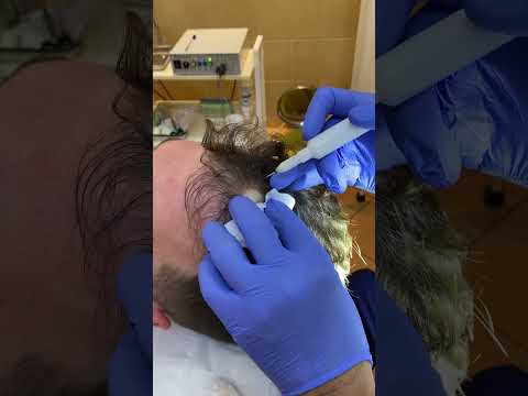 Видео: Удалили атерому на коже головы