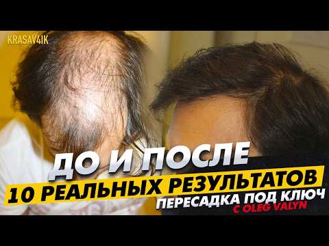 Видео: До и После: впервые показываю реальные результаты пересадки волос \ KRASAV4IK