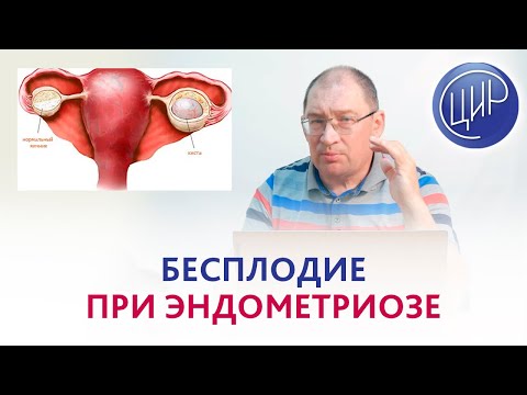 Видео: Бесплодие при эндометриозе после резекции эндометриоидной кисты яичника. АМГ 0,99. Как забеременеть?