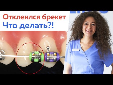 Видео: Что делать, если отклеился брекет? / Можно ли подтягивать брекеты самостоятельно?