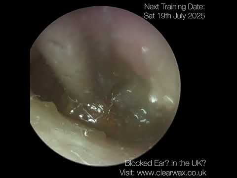 Видео: 1,617 — Удаление ушной серы оказалось сложнее, чем ожидалось