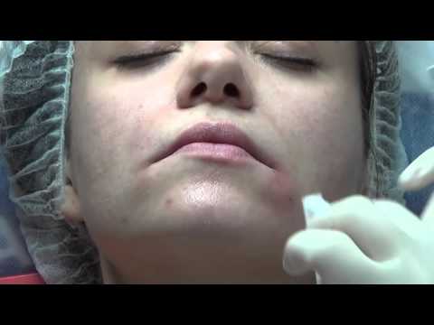 Видео: «Улыбка Мона Лизы» — подъем опущенных уголков рта за 1 процедуру