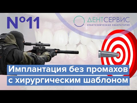Видео: Хирургический шаблон для имплантации