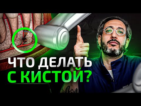 Видео: Киста зуба, что делать – лечить или удалять?