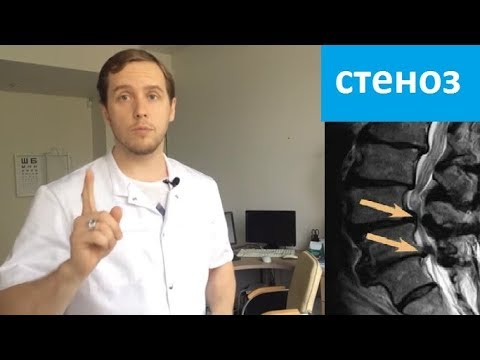 Видео: Стеноз позвоночного канала