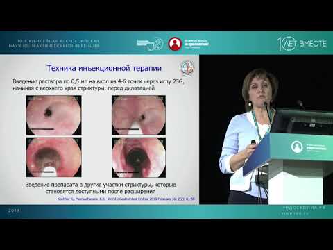 Видео: Современные тенденции в эндоскопическом лечении рубцовых стриктур пищевода и пищеводных анастомозов