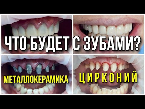 Видео: Что выбрать, металлокерамику или цирконий? Имплантация зубов.