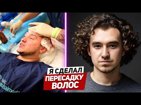 Видео: Я ЛЫСЕЮ / ПЕРЕСАДКА ВОЛОС !