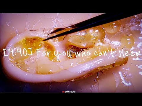 Видео: ASMR [4:40] Для тех, кто не может спать сегодня вечером Чистка ушей, это нормально слышать всю ночь