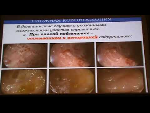 Видео: 11 Веселов ВВ Сложная колоноскопия Способы и средства преодоления