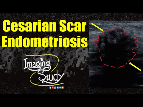 Видео: Эндометриоз рубца после кесарева сечения || Ультразвуковое исследование || Случай 362