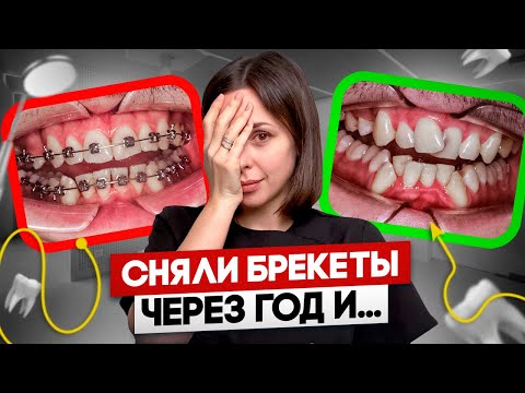 Видео: Не совершай эту ОШИБКУ! За какое ВРЕМЯ можно исправить прикус?