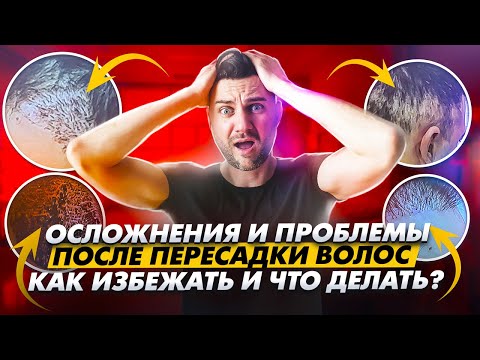 Видео: 🔴 Популярные проблемы после пересадки волос: как избежать и что делать если они появились? KRASAV4IK