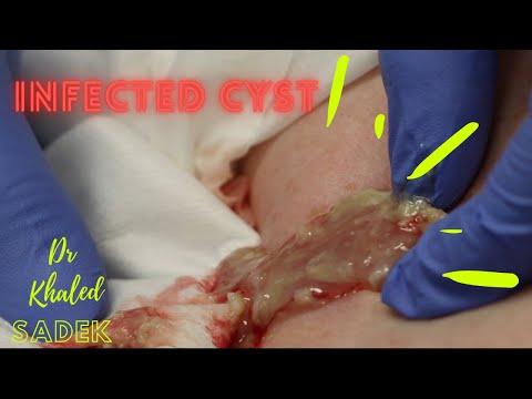 Видео: Инфицированная киста спины. Доктор Халед Садек. LipomaCyst.com