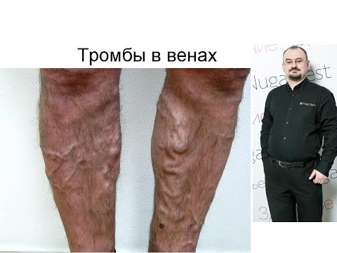 Видео: Тромбы в венах