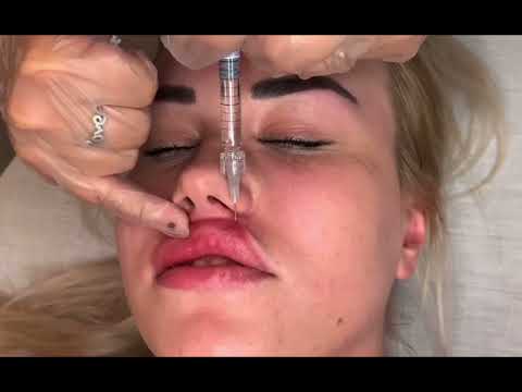 Видео: Увеличение губ ❤️ линейная, Парижская, классическая техника.