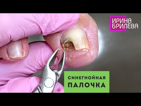 Видео: Бактерия под ногтем (синегнойная палочка) 🌸 Сложный педикюр 🌸 Онихолизис 🌸 Ирина Брилёва