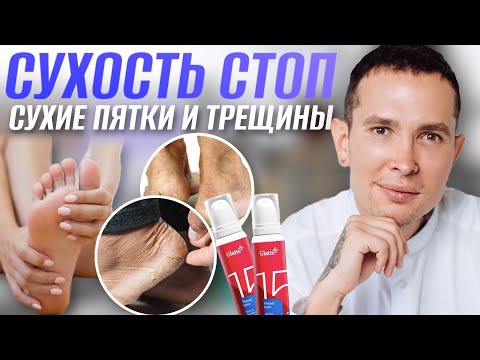 Видео: Сухость стоп и трещины | Причины и предотвращение | Самый эффективный способ лечения