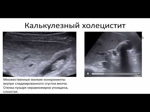 Видео: Ультразвуковая диагностика желчекаменной болезни.