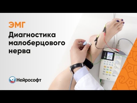 Видео: ЭМГ: Диагностика Малоберцового Нерва