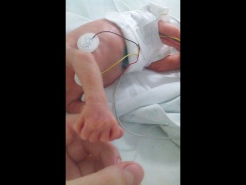 Видео: Ребенок родился на 3 месяца раньше \ Преждевременн