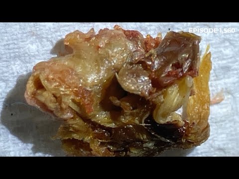 Видео: 1560 - Удаление сложного обтурирующего кератоза III степени