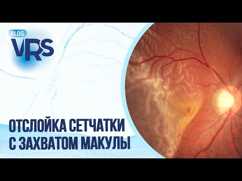 Видео: Отслойка сетчатки с захватом макулы