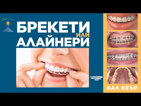 Видео: Брекети или алайнери? Кой е най-добрият избор за красива усмивка?