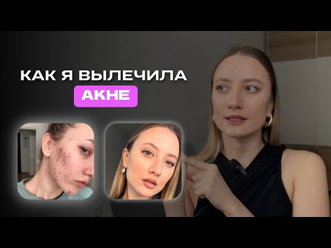 Видео: Мой опыт: как я вылечила акне? | Прыщи лечение без ретиноидов и КОК
