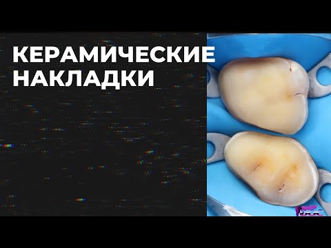 Видео: ОШИБКИ В ОРТОПЕДИИ  КЕРАМИЧЕСКИЕ НАКЛАДКИ часть 4
