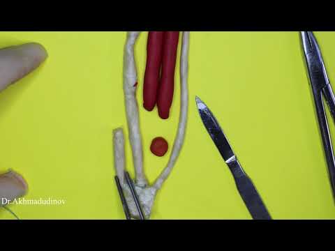 Видео: Пластика пахового канала по Мартынову