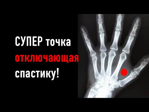 Видео: СУПЕР точка, отключающая спастику!