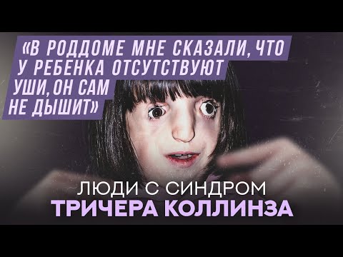 Видео: Люди с синдромом Тричера Коллинза | Хочу спросить