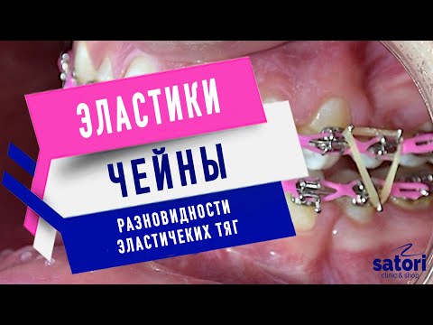 Видео: Как работают тяги на брекетах. Межчелюстные тяги, резинки на брекетах.