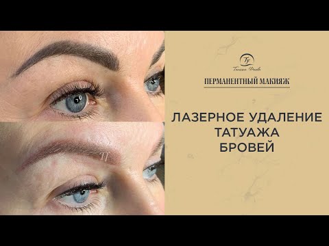 Видео: Лазерное удаление татуажа бровей