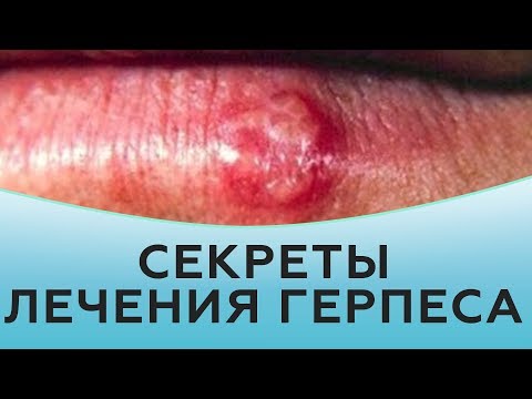 Видео: Секреты лечения герпеса