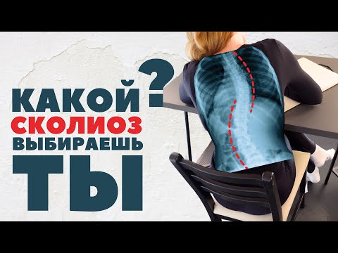Видео: Сколиоз не уйдет, пока ты не уберешь этот фактор. Истинные причины идиопатического сколиоза