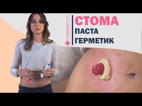 Видео: Обзор герметиков для стомы | Стерильно.com