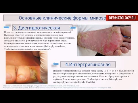 Видео: «Уродерм – эффективное наружное средство в комплексной терапии грибковых поражений кожи и ногтей».