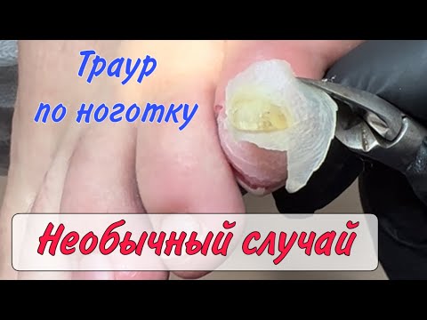 Видео: Пузырь на ноге / влажная мозоль / как убрать мозоль / волдырь на ноге