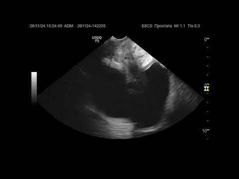 Видео: УЗИ. Доктор Иогансен. Видеопримеры. Выпуск 107. Гиперплазия предстательной железы (2).