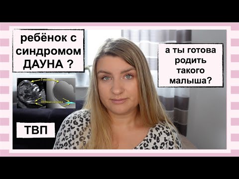 Видео: ТОЛЩИНА ВОРОТНИКОВОГО ПРОСТРАНСТВА// МОИ СТРАХИ ПО ПОВОДУ РОЖДЕНИЯ РЕБЁНКА С СИНДРОМОМ ДАУНА