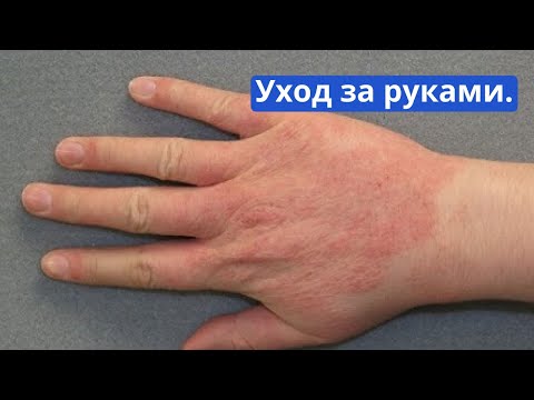 Видео: Уход за руками. Экзема на руках. Очень сухая кожа рук.
